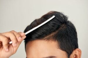 Combining hair loss treatments
