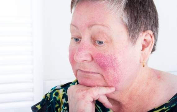 Rosacea Treatments